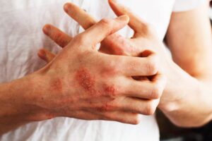 Psoriasi