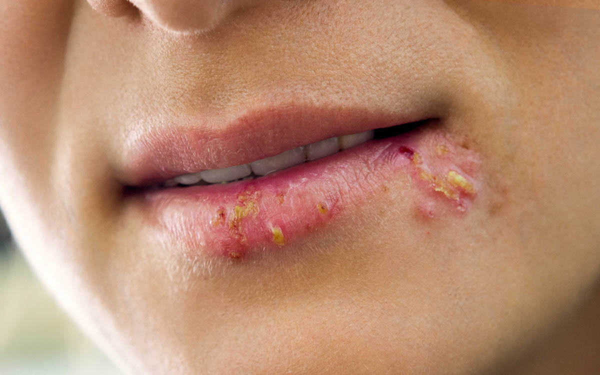 herpes labiale